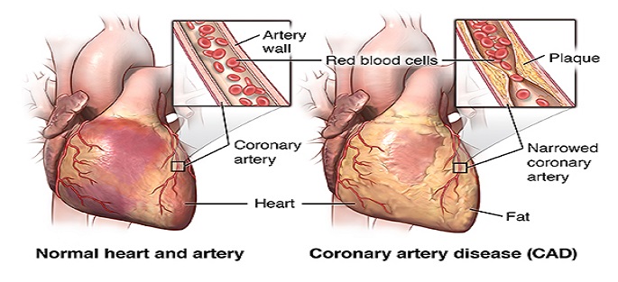 Coronary Stenting Discharge Instructions